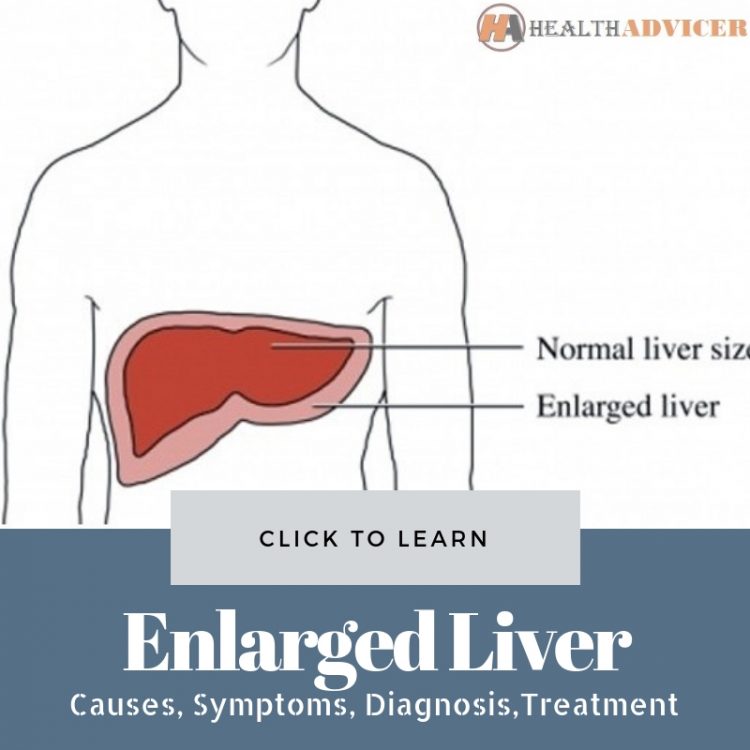 Enlarged Liver Picture
