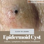 Epidermoid Cyst Picture