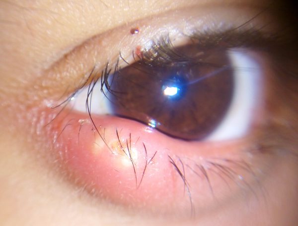 Eye Disorders