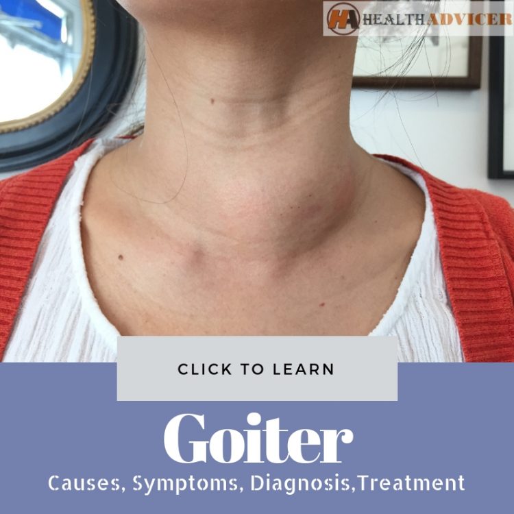 Goiter Causes Picture Symptoms And Treatment