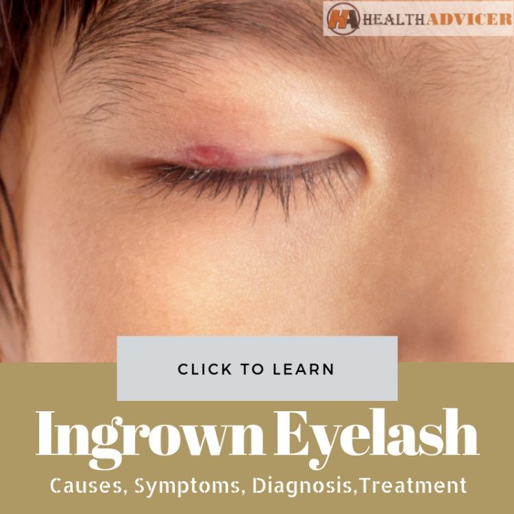 Ingrown Eyelash Picture