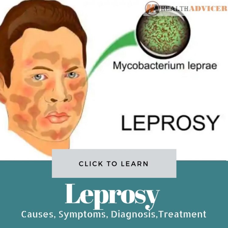 Leprosy Causes Treatment