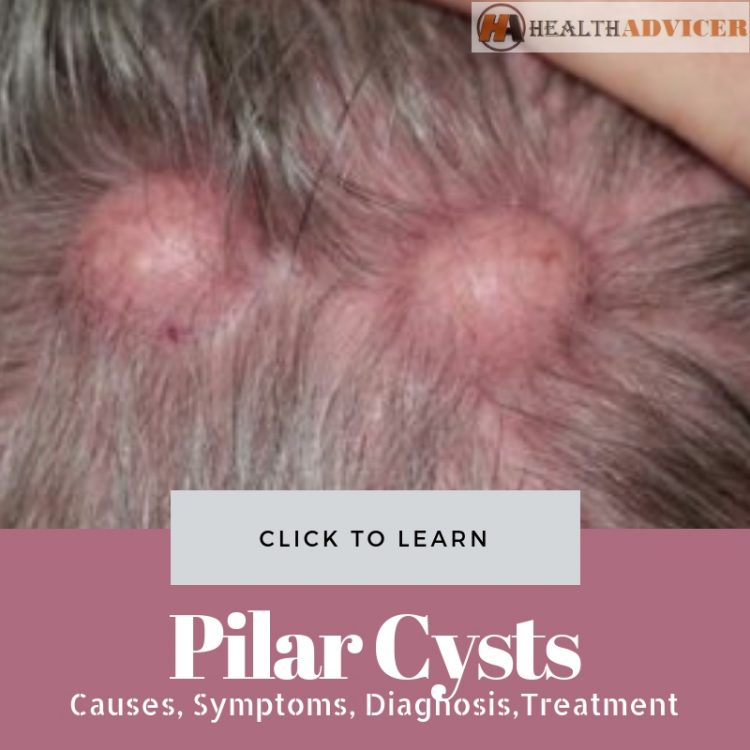 Pilar Cysts Picture