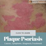 Plaque Psoriasis