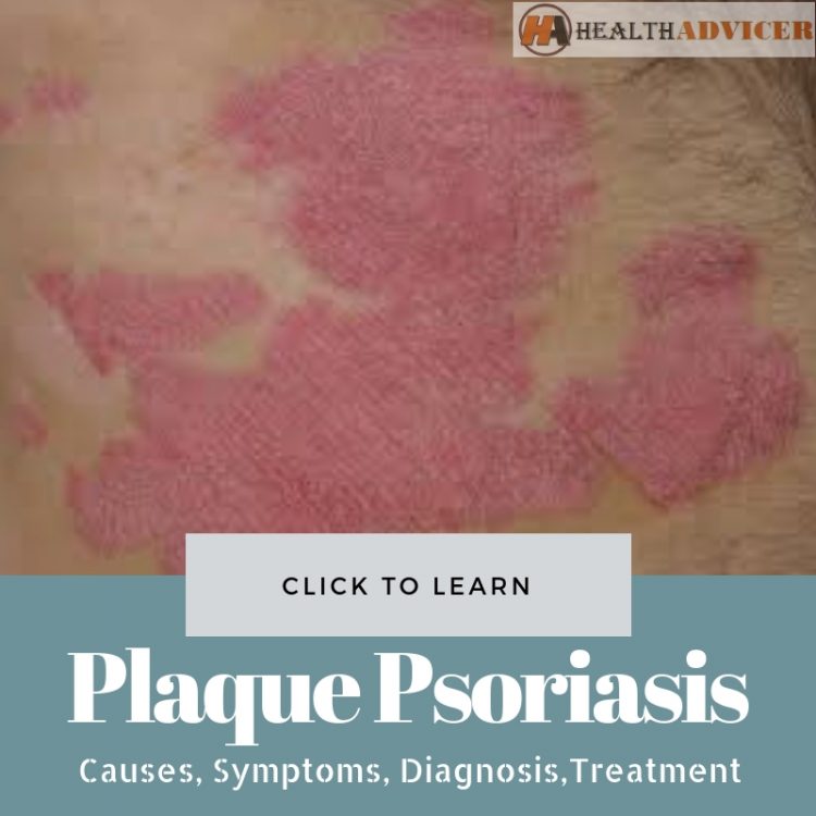 Plaque Psoriasis