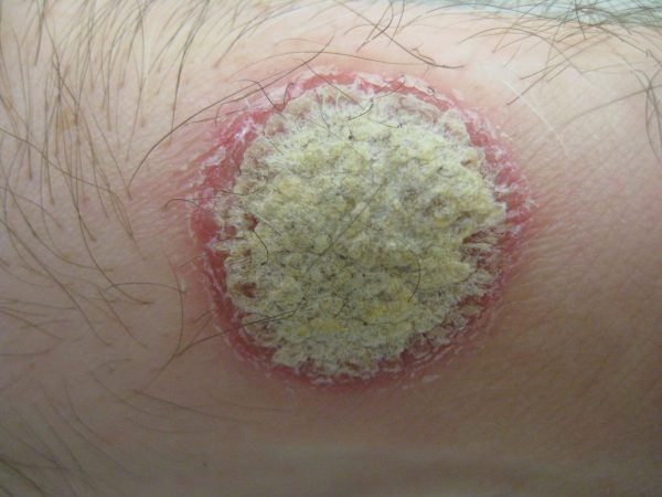 Plaque psoriasis