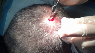 Removing Pilar Cysts Surgically