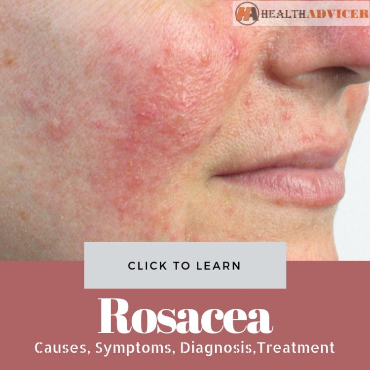 Rosacea Picture Causes Treatment