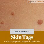 Skin Tags Picture