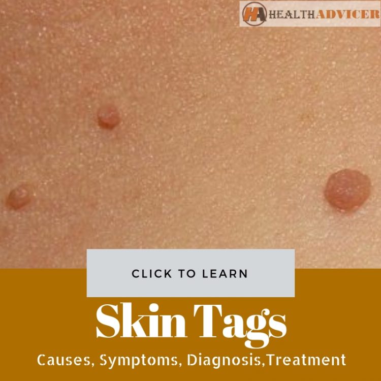 Skin Tags Picture