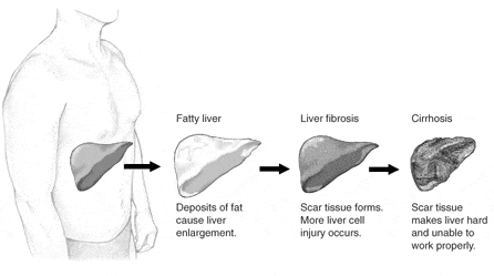 Liver Diseases