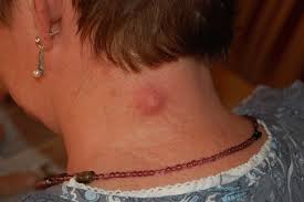 Symptoms Of Epidermoid Cyst