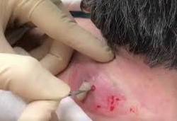 Draining The Cysts