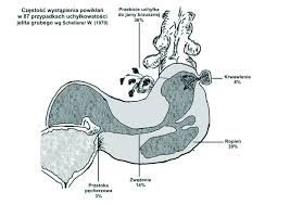 Diverticulitis