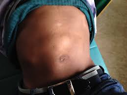 enlarged liver