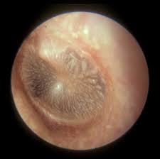 Causes Of Pilar Cysts