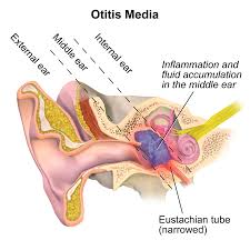 Causes Of Baby Ear Infection
