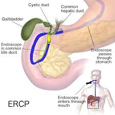 Endoscopic Retrograde Cholangiopancreatography