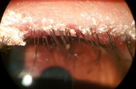 Blepharitis