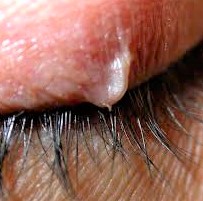 Ingrown Eyelash