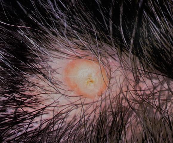 pilar cysts