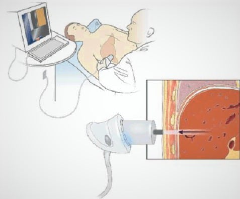 Transient Elastography