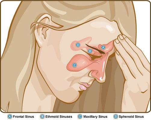 Sinus Headaches