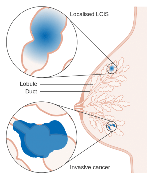 Lobular Carcinoma In Situ