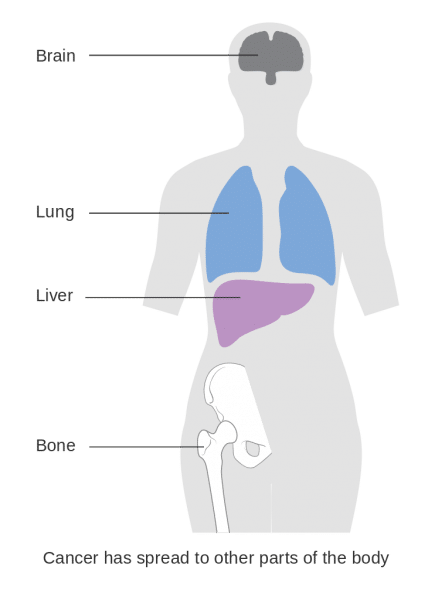 Breast Cancer Stages