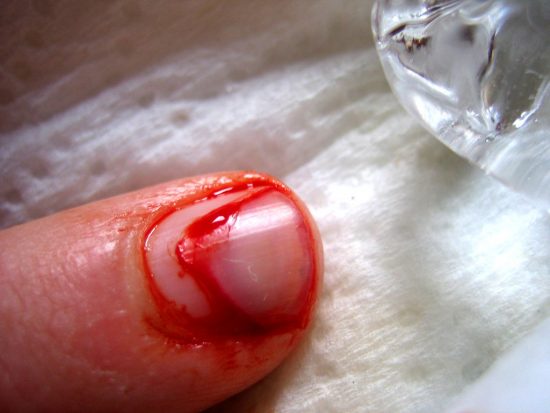 Injury to the nail