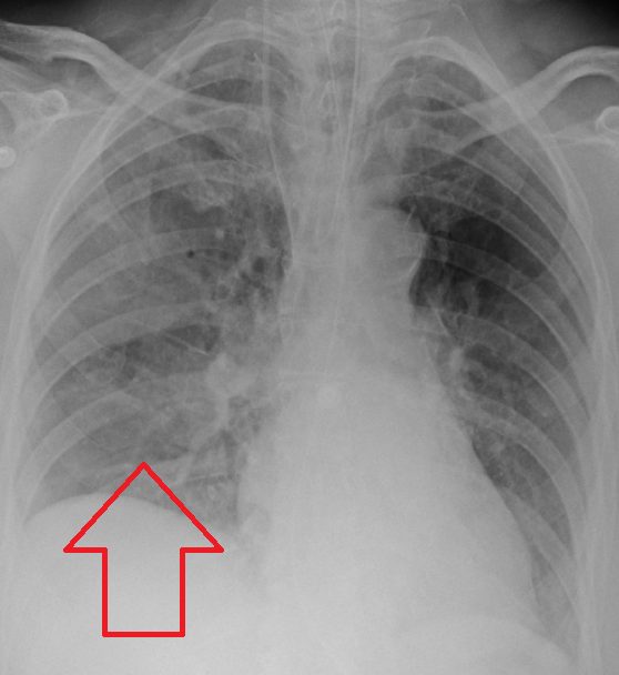 Aspiration Pneumonia