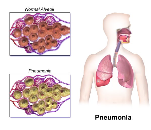 Pneumonia