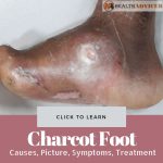 Charcot Foot Picture