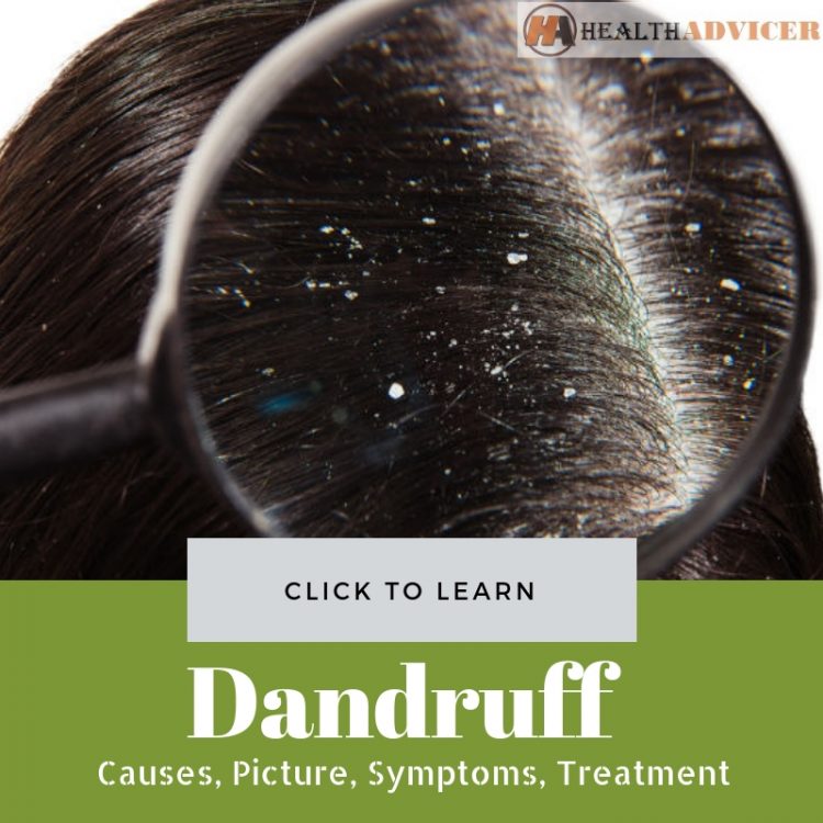 Dandruff Pictures Causes treatment