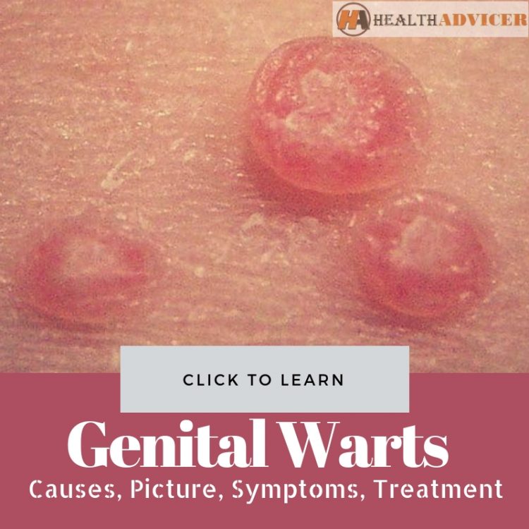 Genital Warts (HPV) Picture