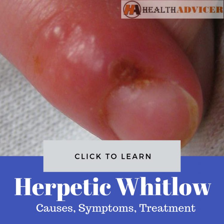 Herpetic Whitlow Picture