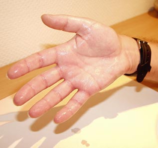 Idiopathic Hyperhidrosis