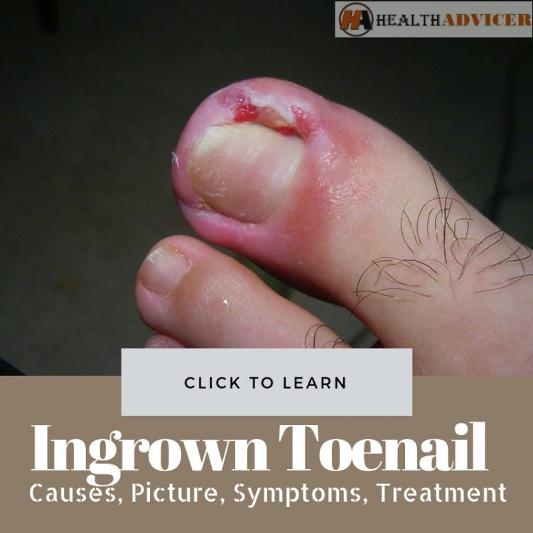 Ingrown Toenail Causes Treatment