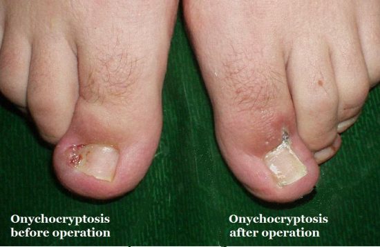 Medical Treatment For Ingrown Toenail