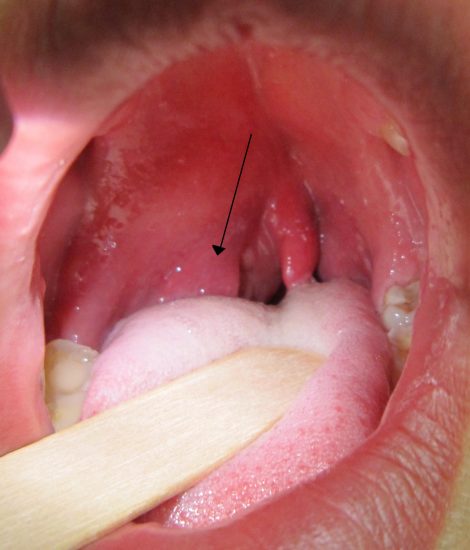 Peritonsillar Abscess