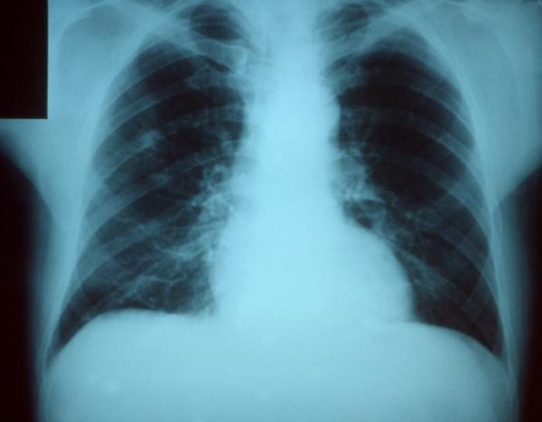 Chest X-ray