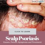 Scalp Psoriasis Causes Treatment