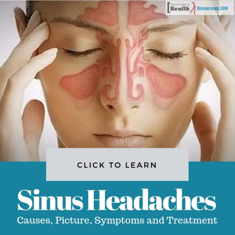 Sinus Headaches Causes Treatment
