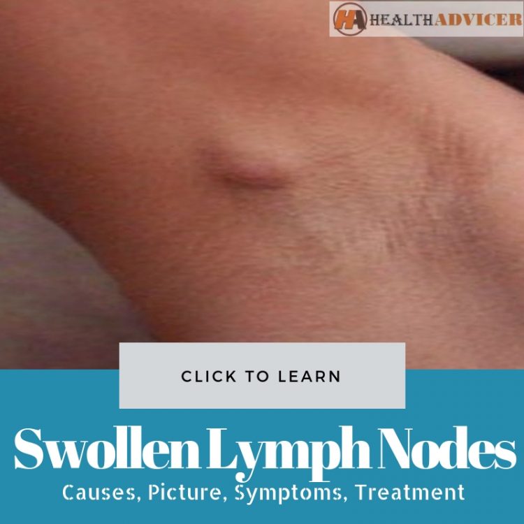 Swollen Lymph Nodes Under The Arm