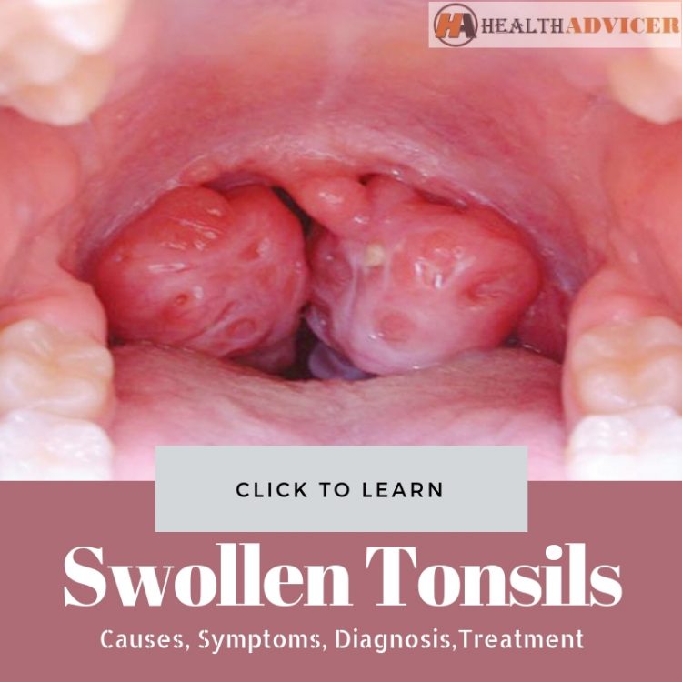 Swollen Tonsils Causes Treatment