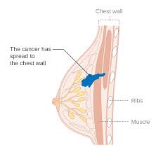 Breast Cancer Stages