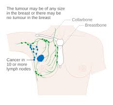 Breast Cancer Stages