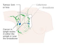 Breast Cancer Stages