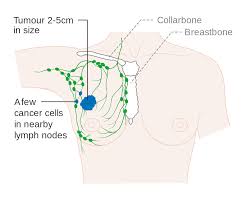 Breast Cancer Stages