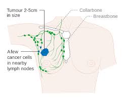 Breast Cancer Stages